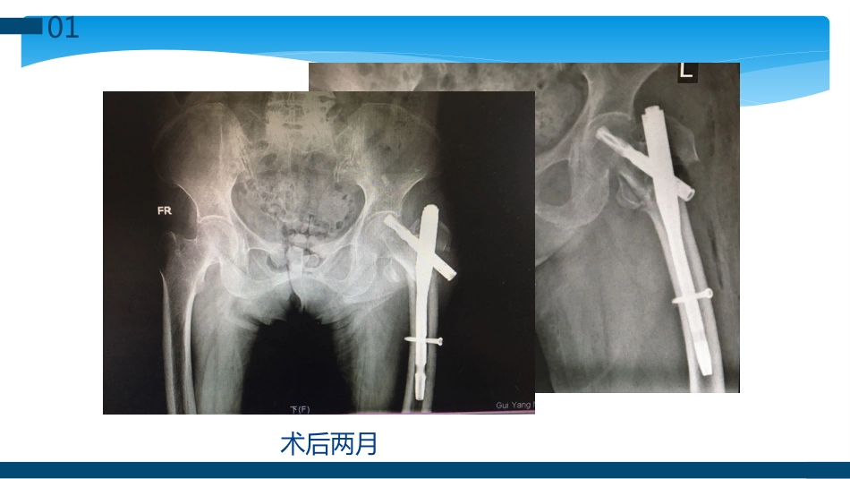 外科学：股骨粗隆间及粗隆下骨折髓内固定辅助技术分享_第5页