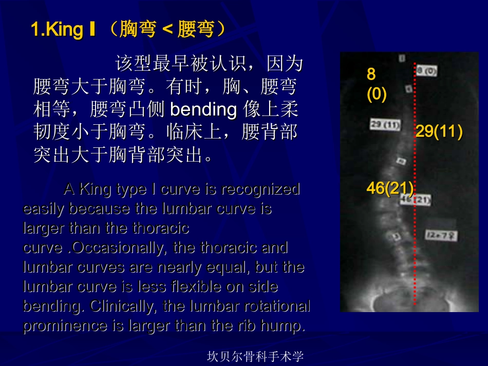 外科学：青少年特发性脊柱侧弯的分型_第11页