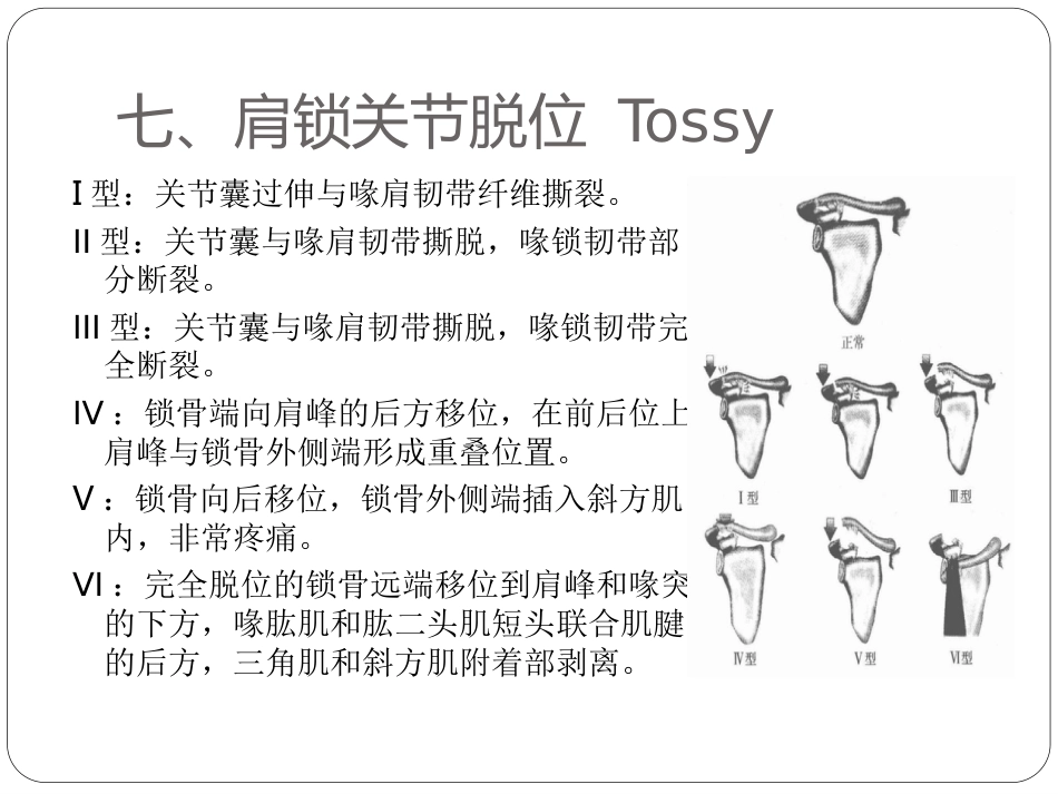 外科学：骨与关节骨折分型_第12页