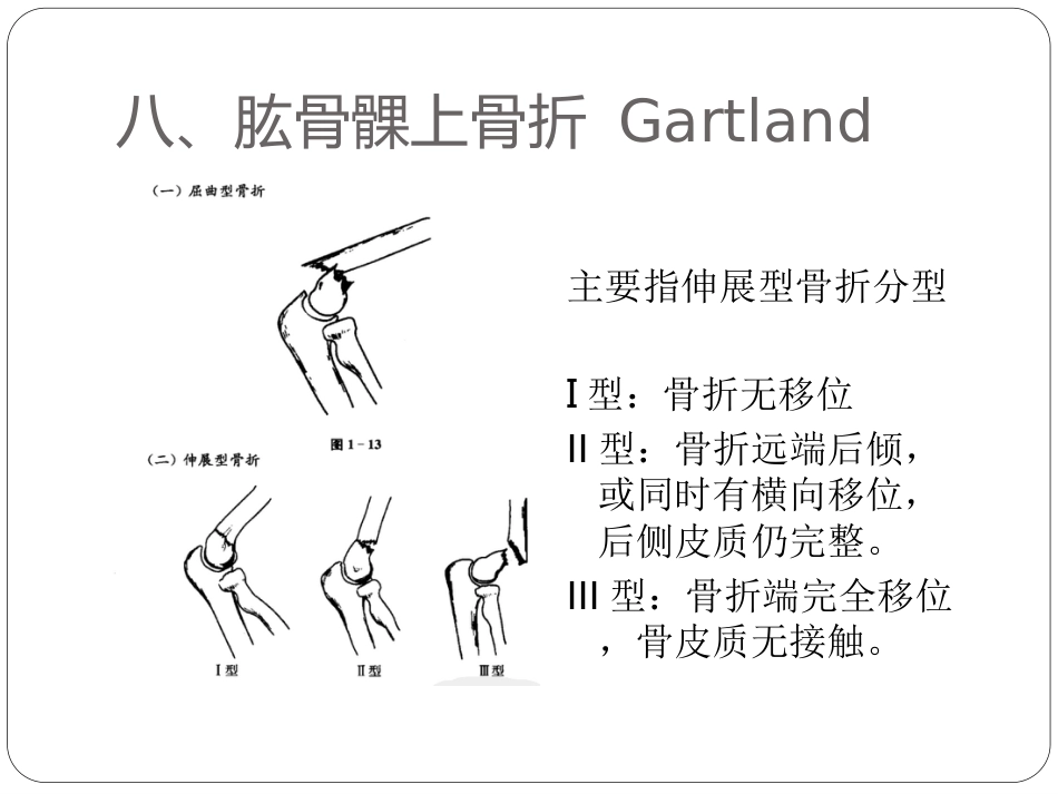 外科学：骨与关节骨折分型_第13页