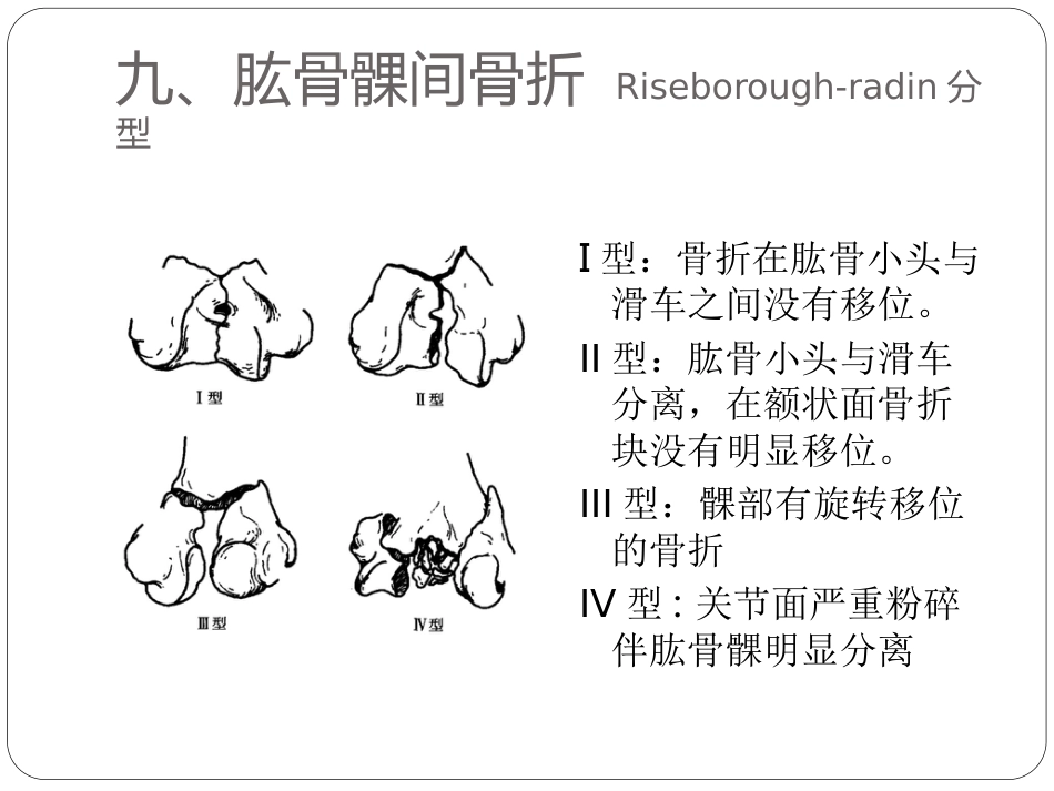外科学：骨与关节骨折分型_第14页