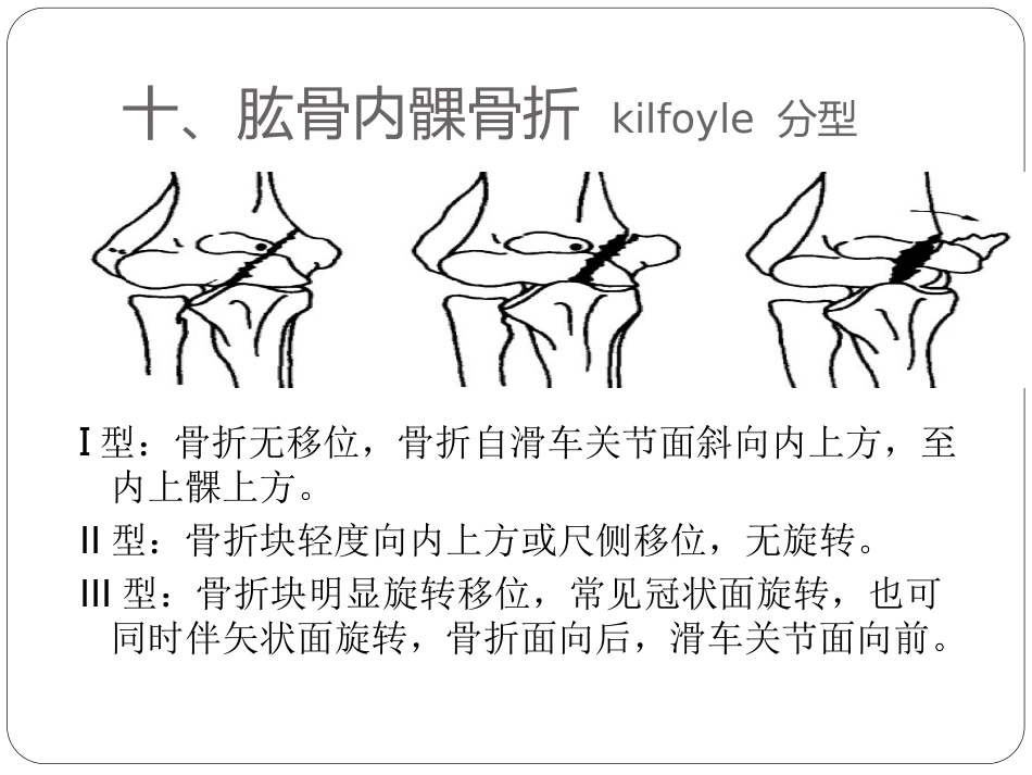 外科学：骨与关节骨折分型_第15页