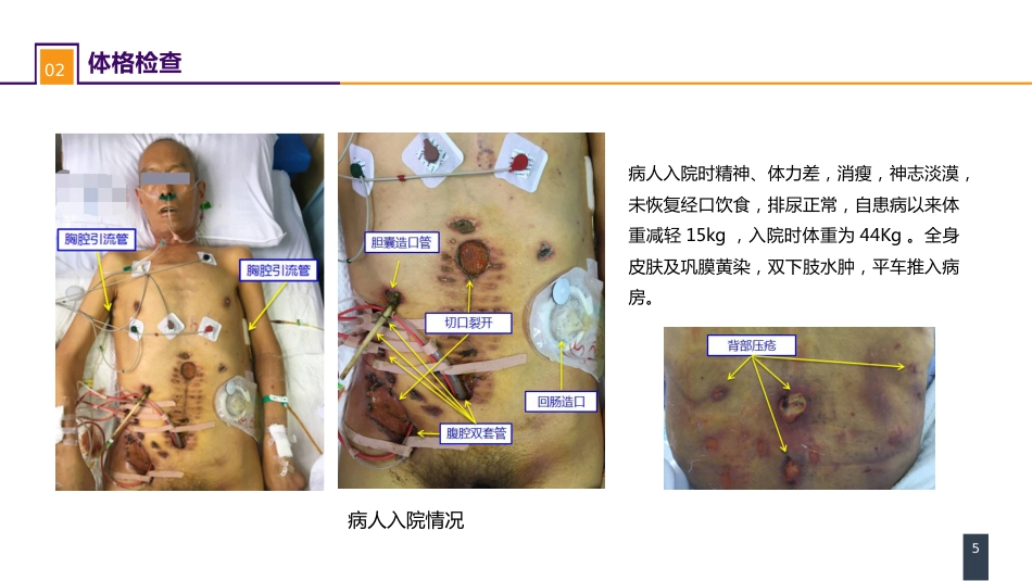 外科学：案例分析-肠瘘、腹腔感染合并脓毒症_第5页