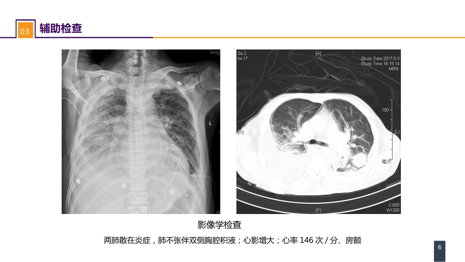外科学：案例分析-肠瘘、腹腔感染合并脓毒症_第6页