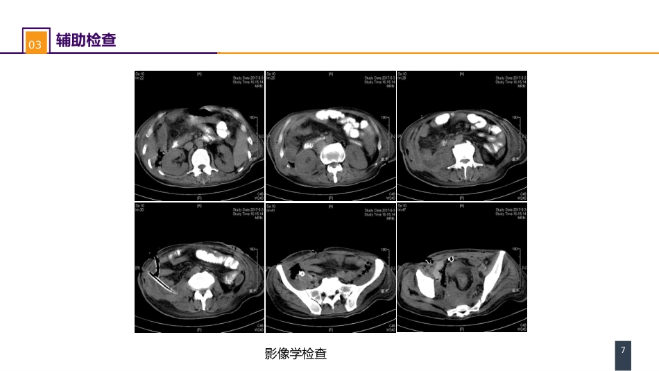 外科学：案例分析-肠瘘、腹腔感染合并脓毒症_第7页