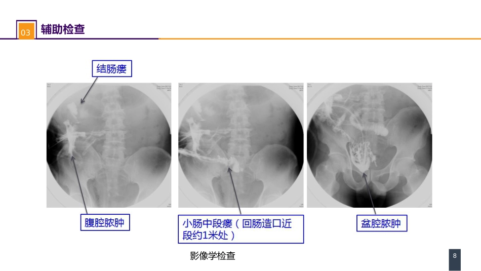 外科学：案例分析-肠瘘、腹腔感染合并脓毒症_第8页