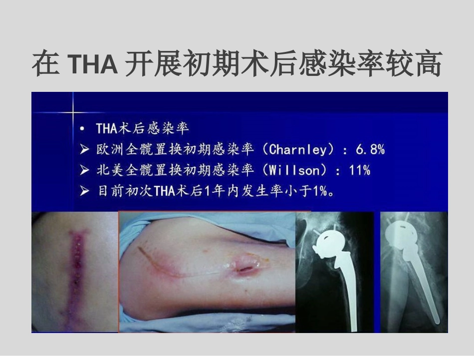 外科学：冲击波疗法治疗股骨头坏死_第13页