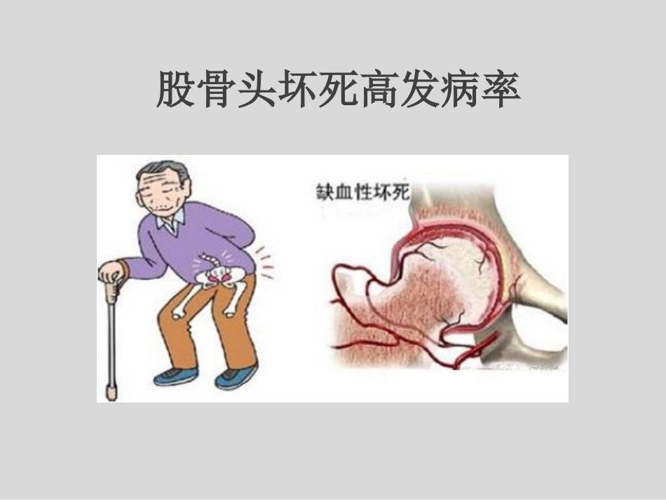 外科学：冲击波疗法治疗股骨头坏死_第2页
