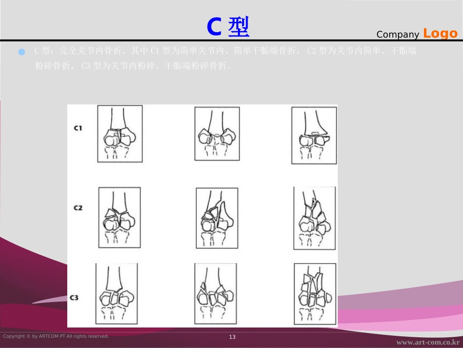 外科学：骨折治疗的AO原则-肱骨远端_第13页