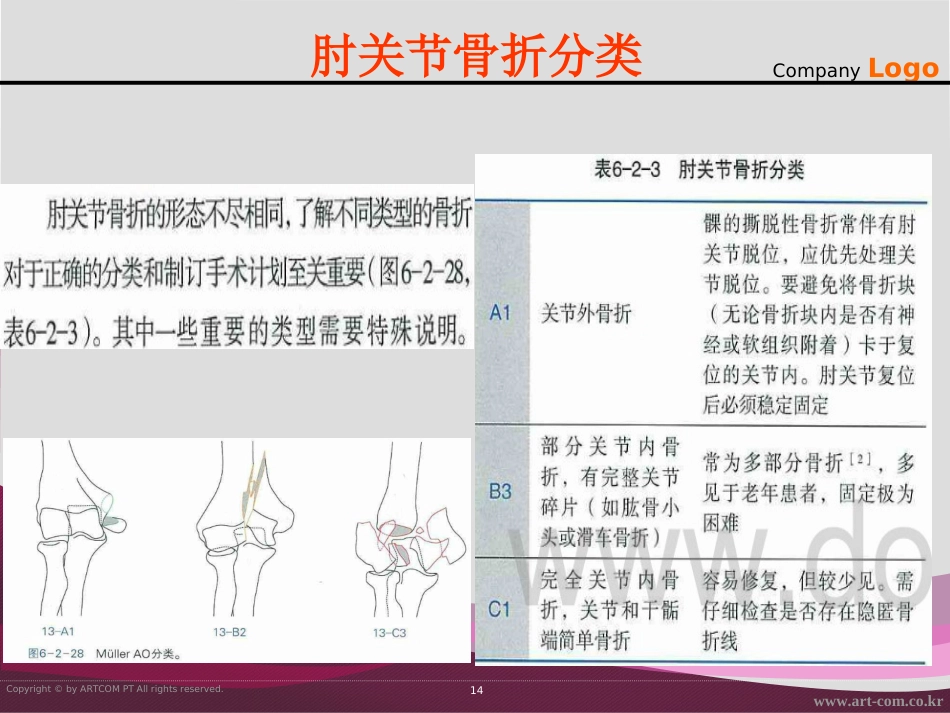外科学：骨折治疗的AO原则-肱骨远端_第14页