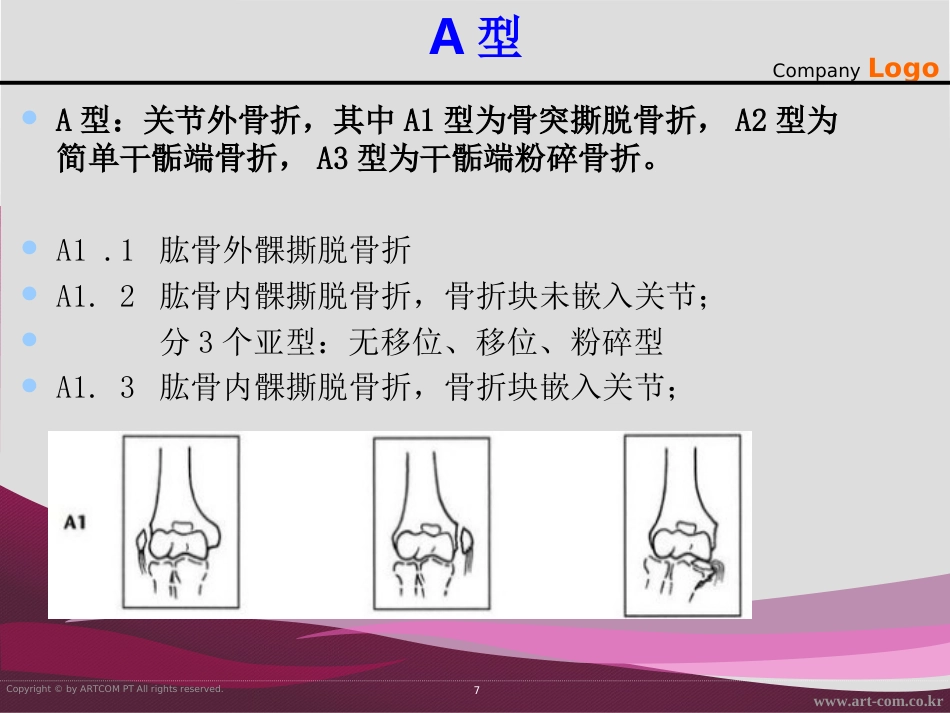 外科学：骨折治疗的AO原则-肱骨远端_第7页