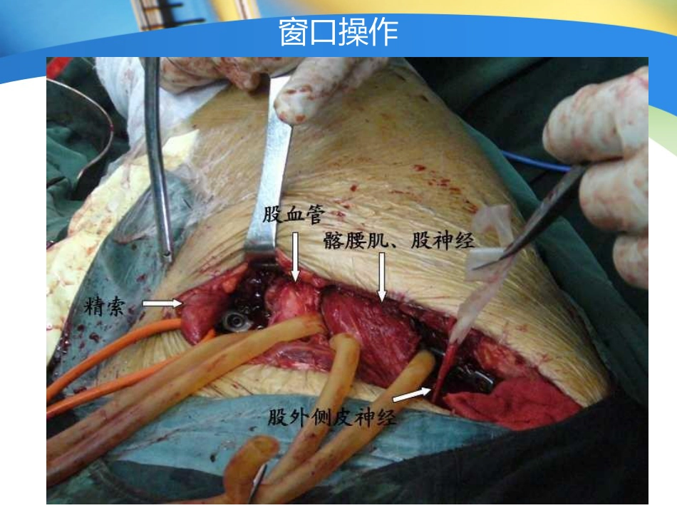外科学：骨盆髋臼入路选择_第13页