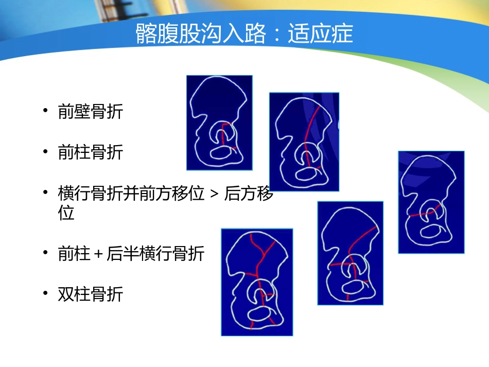 外科学：骨盆髋臼入路选择_第7页