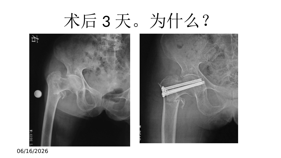 外科学：股骨转子间骨折的复位难点及对策_第10页