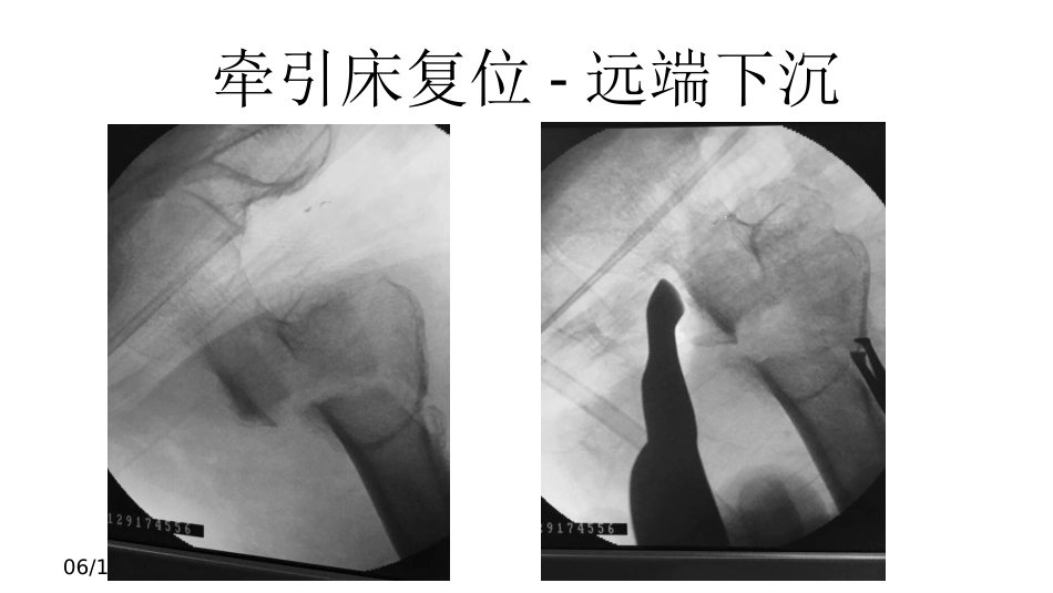 外科学：股骨转子间骨折的复位难点及对策_第11页