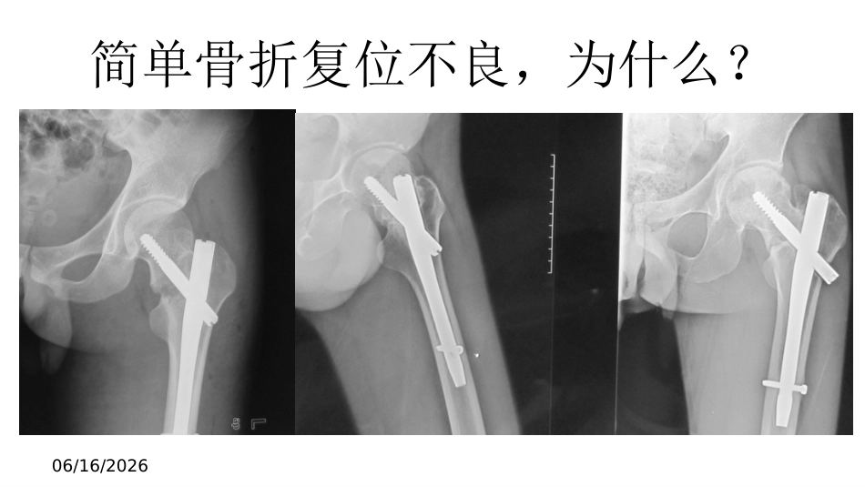 外科学：股骨转子间骨折的复位难点及对策_第12页