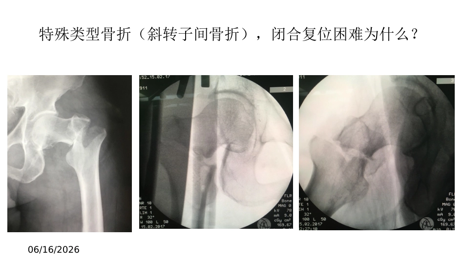 外科学：股骨转子间骨折的复位难点及对策_第13页