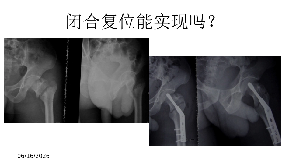 外科学：股骨转子间骨折的复位难点及对策_第14页