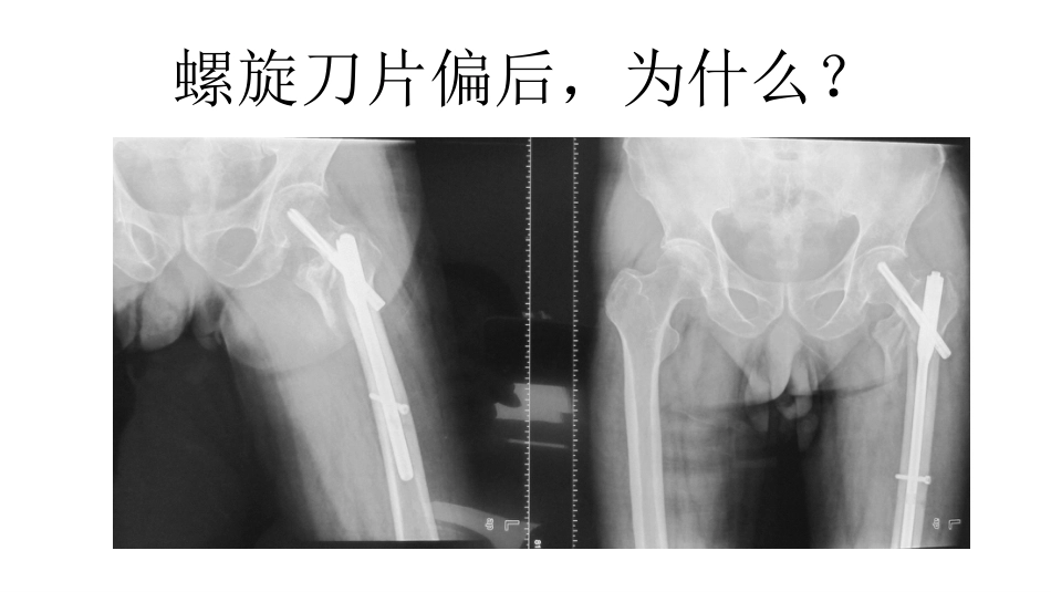 外科学：股骨转子间骨折的复位难点及对策_第5页