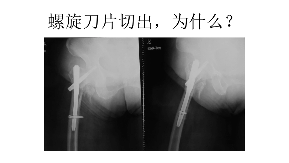 外科学：股骨转子间骨折的复位难点及对策_第6页