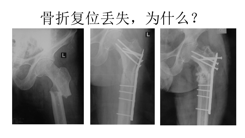 外科学：股骨转子间骨折的复位难点及对策_第7页