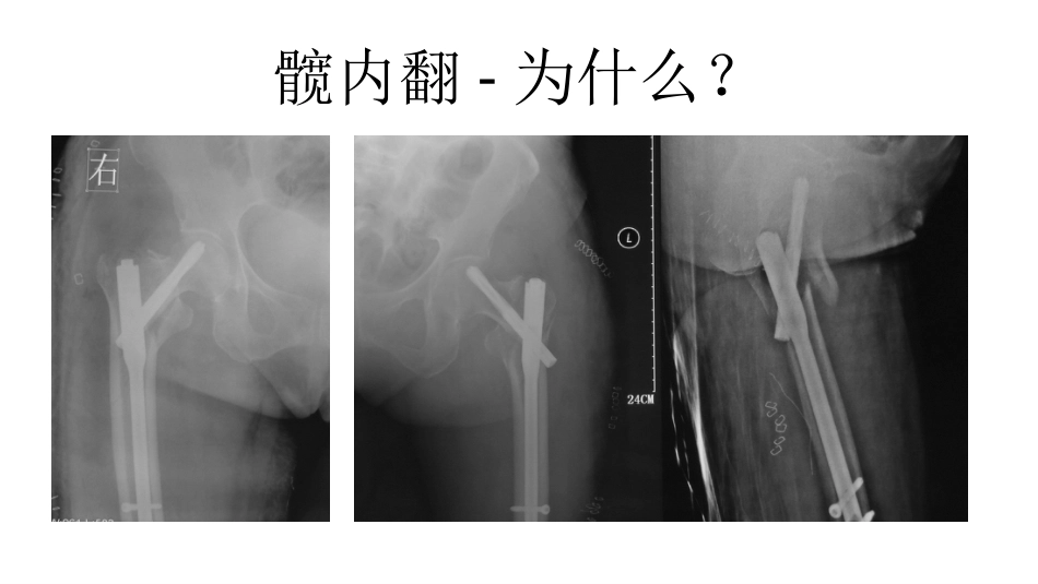 外科学：股骨转子间骨折的复位难点及对策_第8页