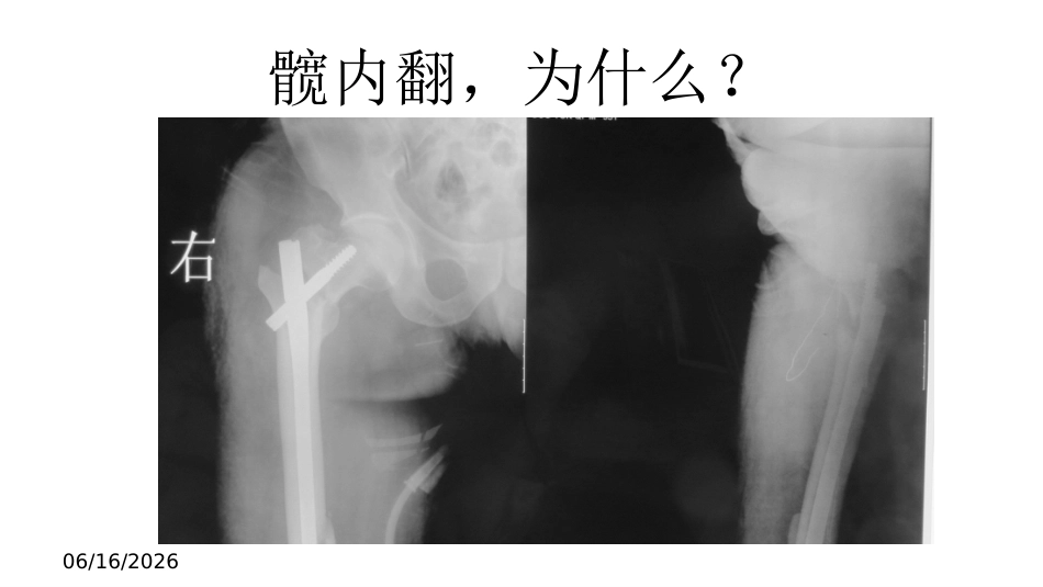 外科学：股骨转子间骨折的复位难点及对策_第9页