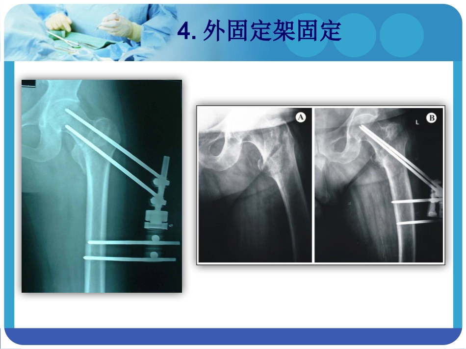 外科学：PFNA在股骨粗隆间骨折的应用_第10页