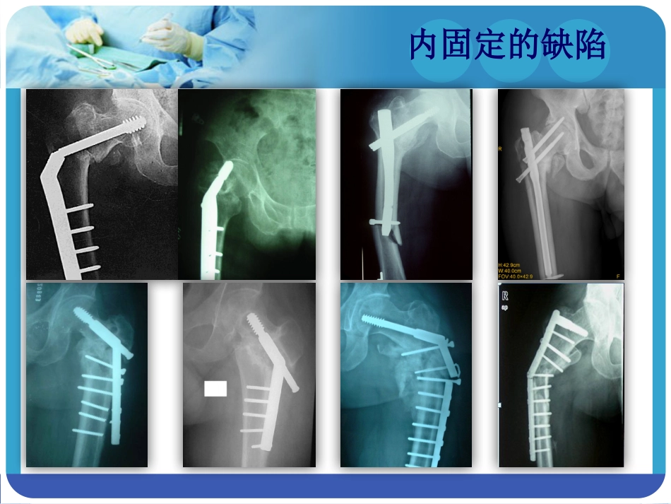 外科学：PFNA在股骨粗隆间骨折的应用_第11页