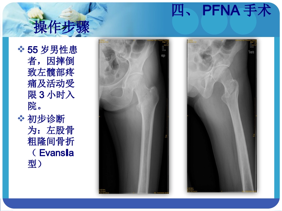外科学：PFNA在股骨粗隆间骨折的应用_第14页