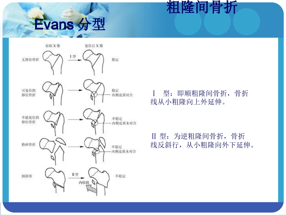 外科学：PFNA在股骨粗隆间骨折的应用_第4页