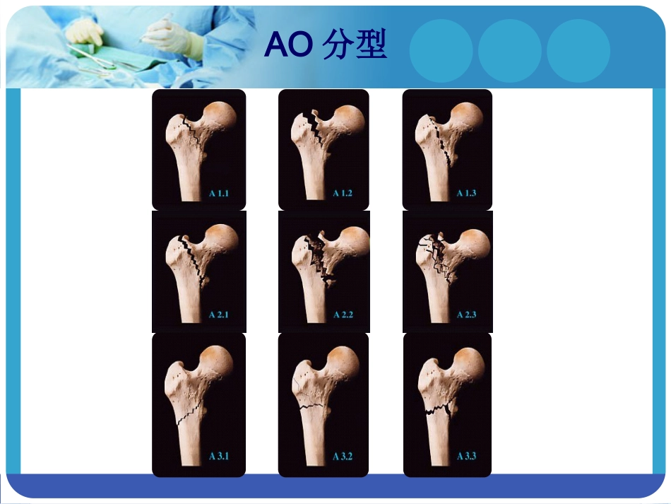 外科学：PFNA在股骨粗隆间骨折的应用_第5页