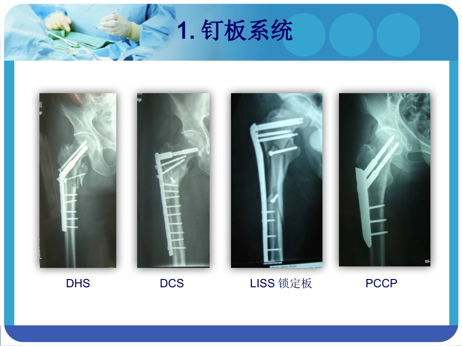 外科学：PFNA在股骨粗隆间骨折的应用_第7页