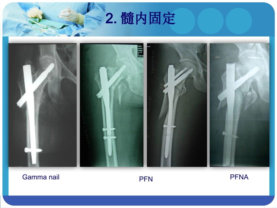 外科学：PFNA在股骨粗隆间骨折的应用_第8页