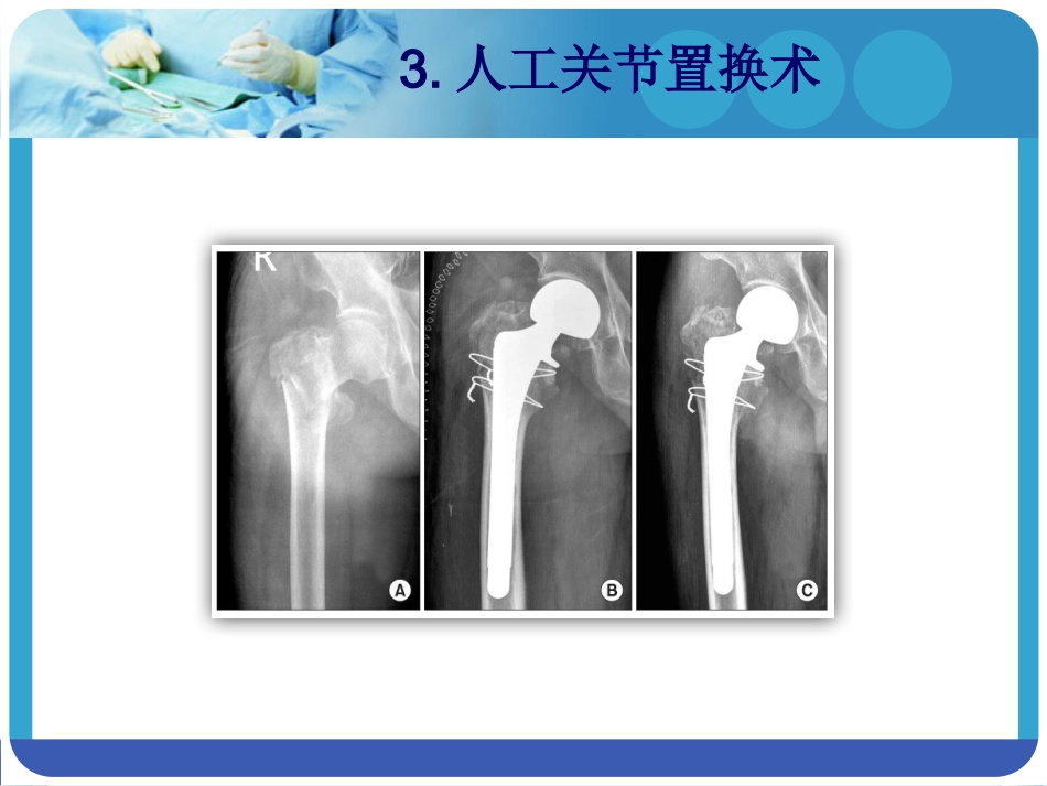 外科学：PFNA在股骨粗隆间骨折的应用_第9页