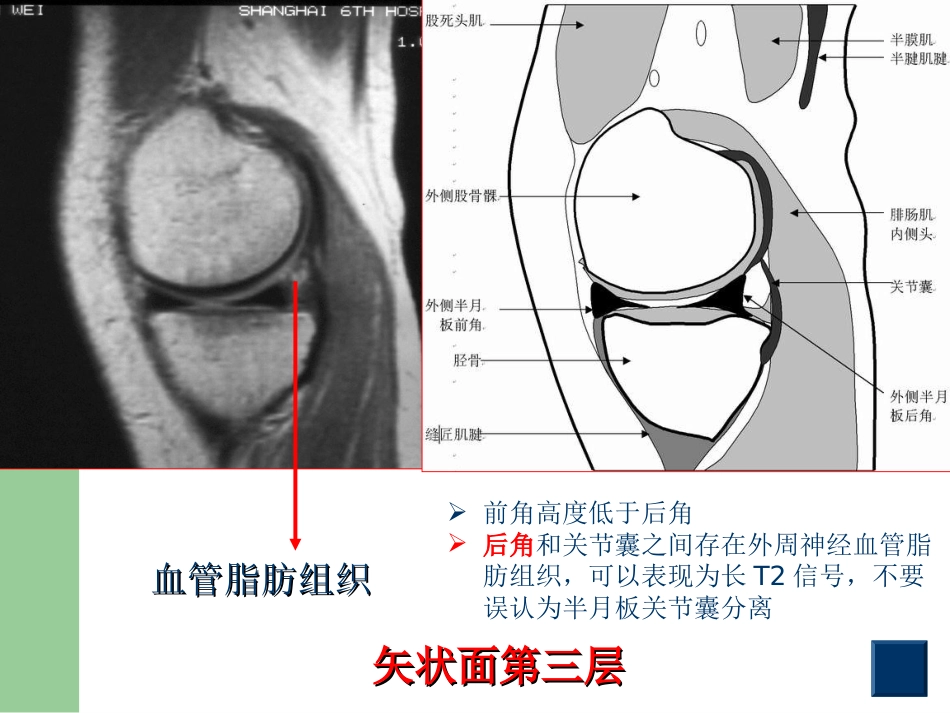 外科学：膝关节半月板损伤MRI诊断(ppt)_第10页