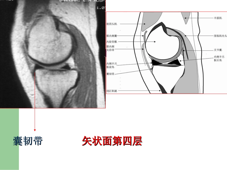 外科学：膝关节半月板损伤MRI诊断(ppt)_第11页