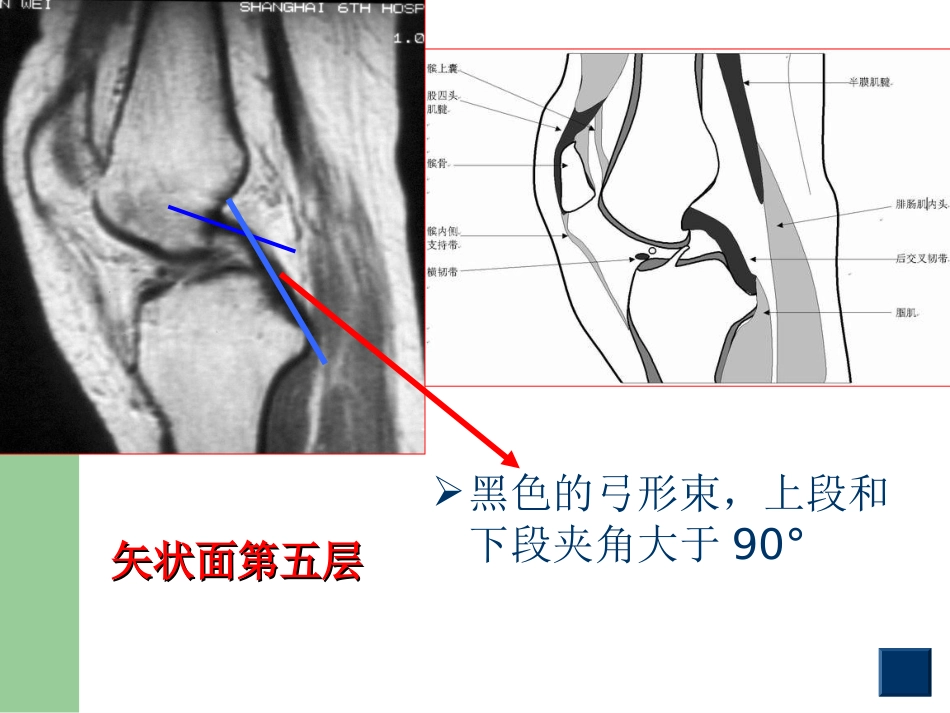 外科学：膝关节半月板损伤MRI诊断(ppt)_第12页