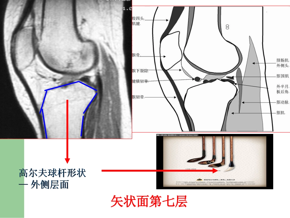 外科学：膝关节半月板损伤MRI诊断(ppt)_第14页