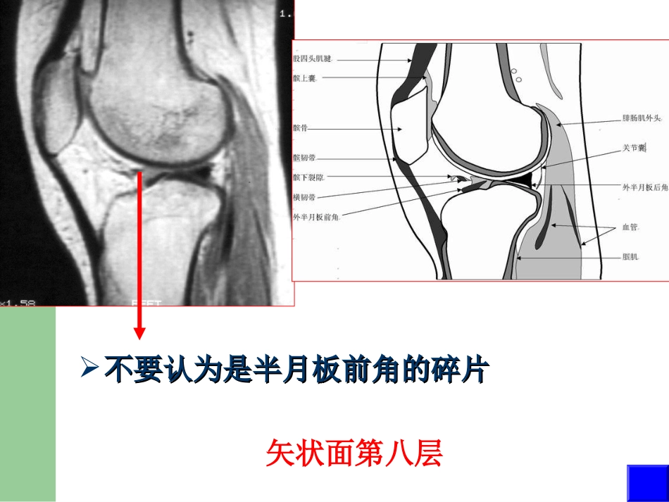外科学：膝关节半月板损伤MRI诊断(ppt)_第15页