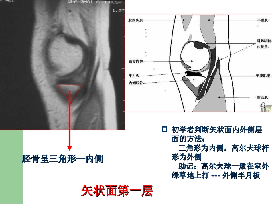 外科学：膝关节半月板损伤MRI诊断(ppt)_第8页