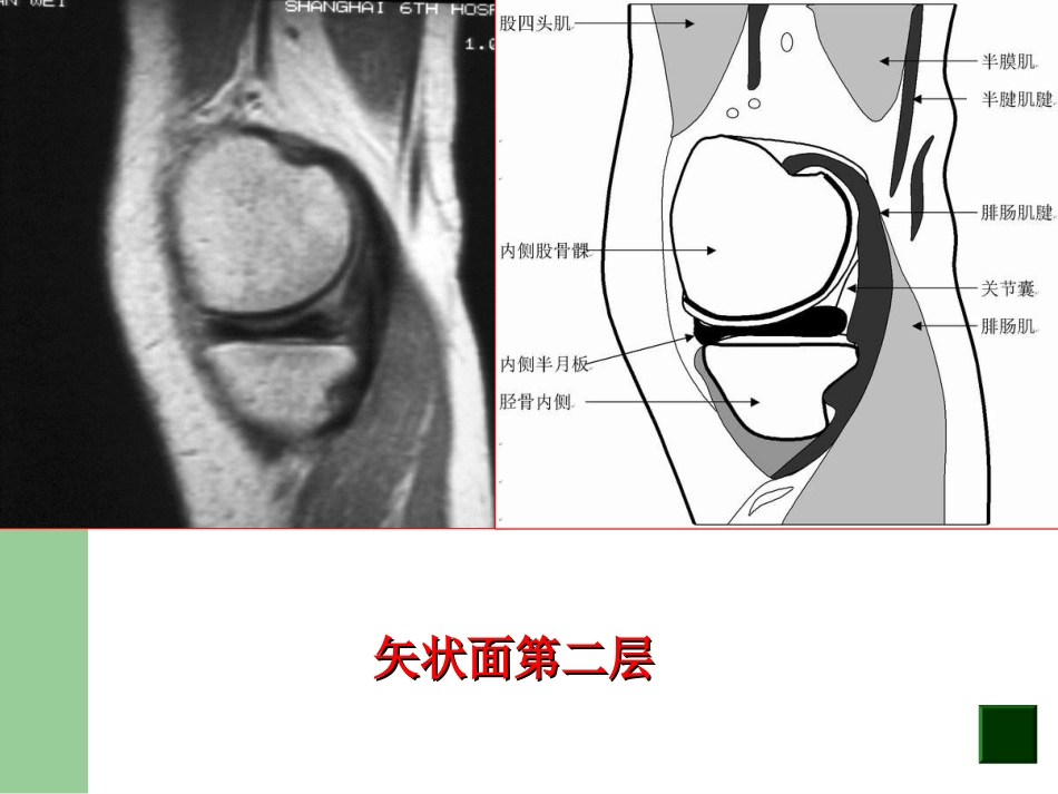 外科学：膝关节半月板损伤MRI诊断(ppt)_第9页