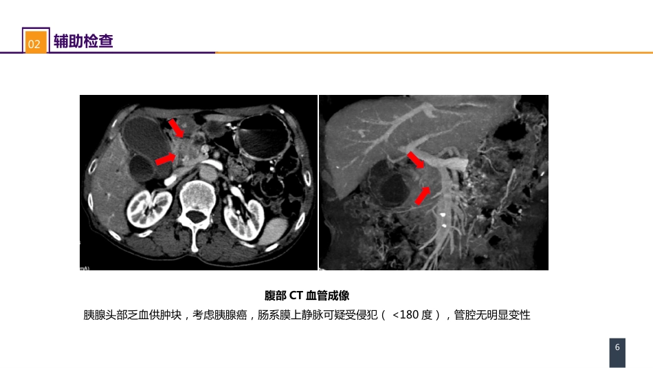 外科学：案例分析-ERAS路径下胰十二指肠切除术一例_第6页