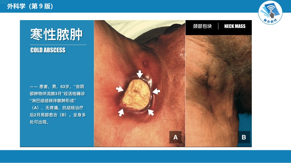 外科学：颈部疾病（颈淋巴结结核，颈部包块）_第6页