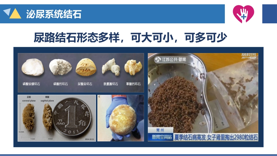 经皮肾镜碎石术手术配合_第5页