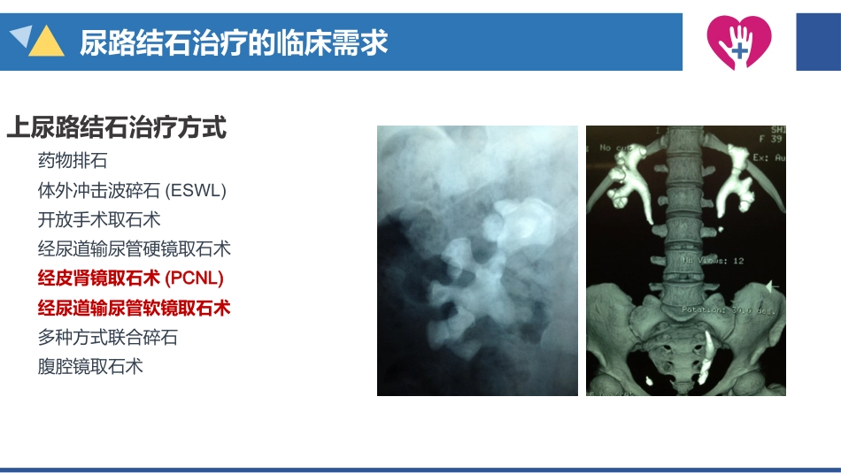 经皮肾镜碎石术手术配合_第6页