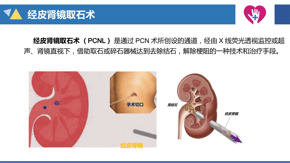 经皮肾镜碎石术手术配合_第7页