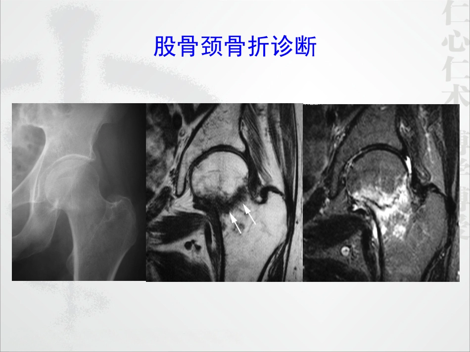 外科学：股骨颈骨折的诊断和治疗翻译_第11页