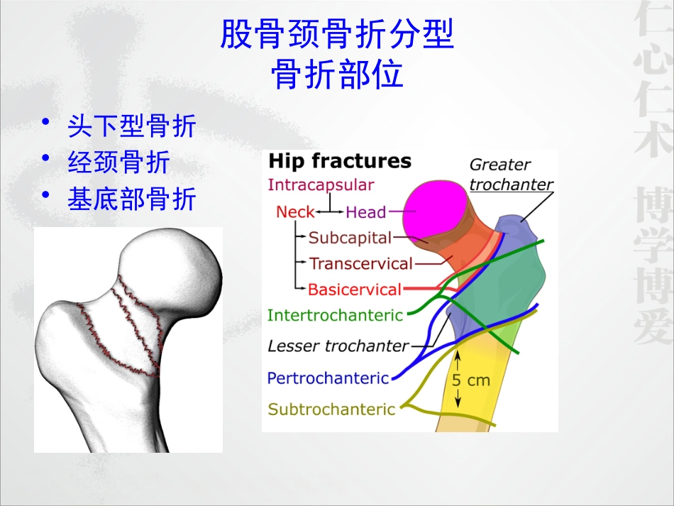 外科学：股骨颈骨折的诊断和治疗翻译_第5页