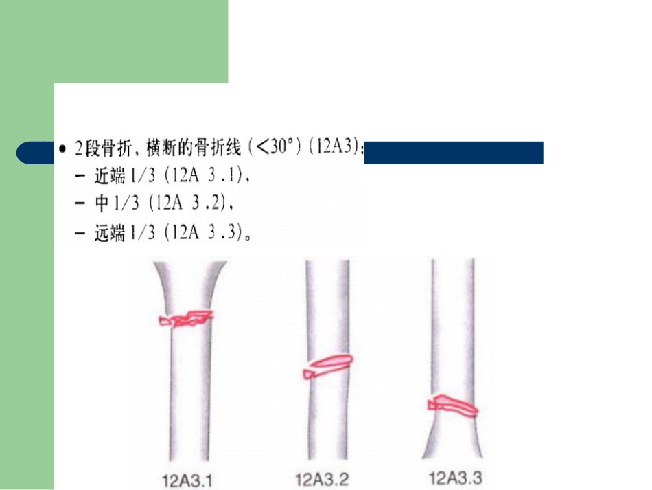 外科学：骨折分型_第10页